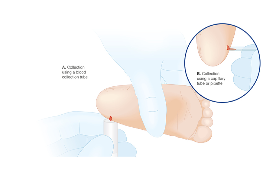 Collecting a heel capillary blood sample