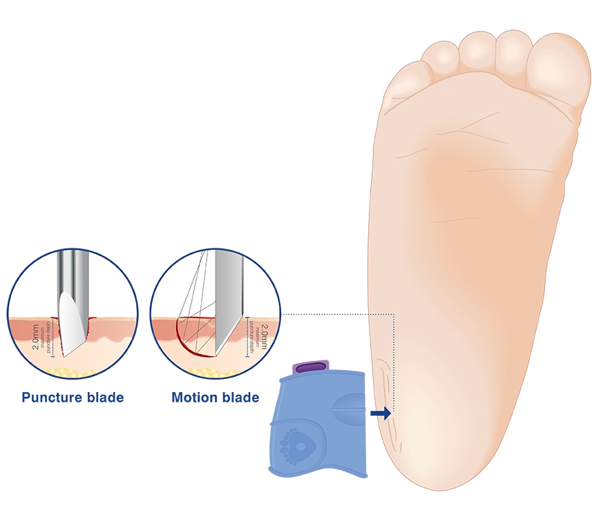 Heel sampling puncture depth 